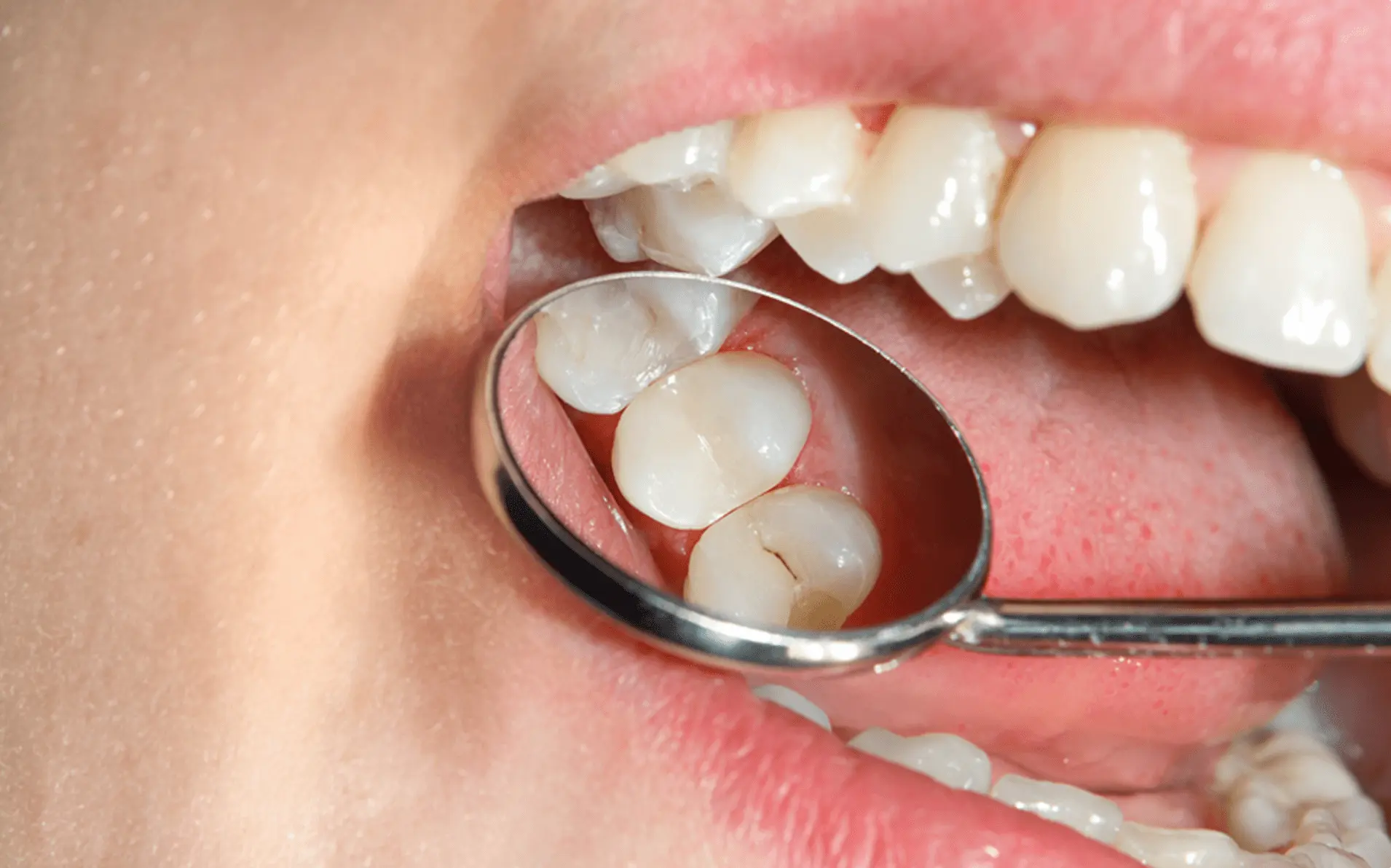 Restauración Dental (Calza)