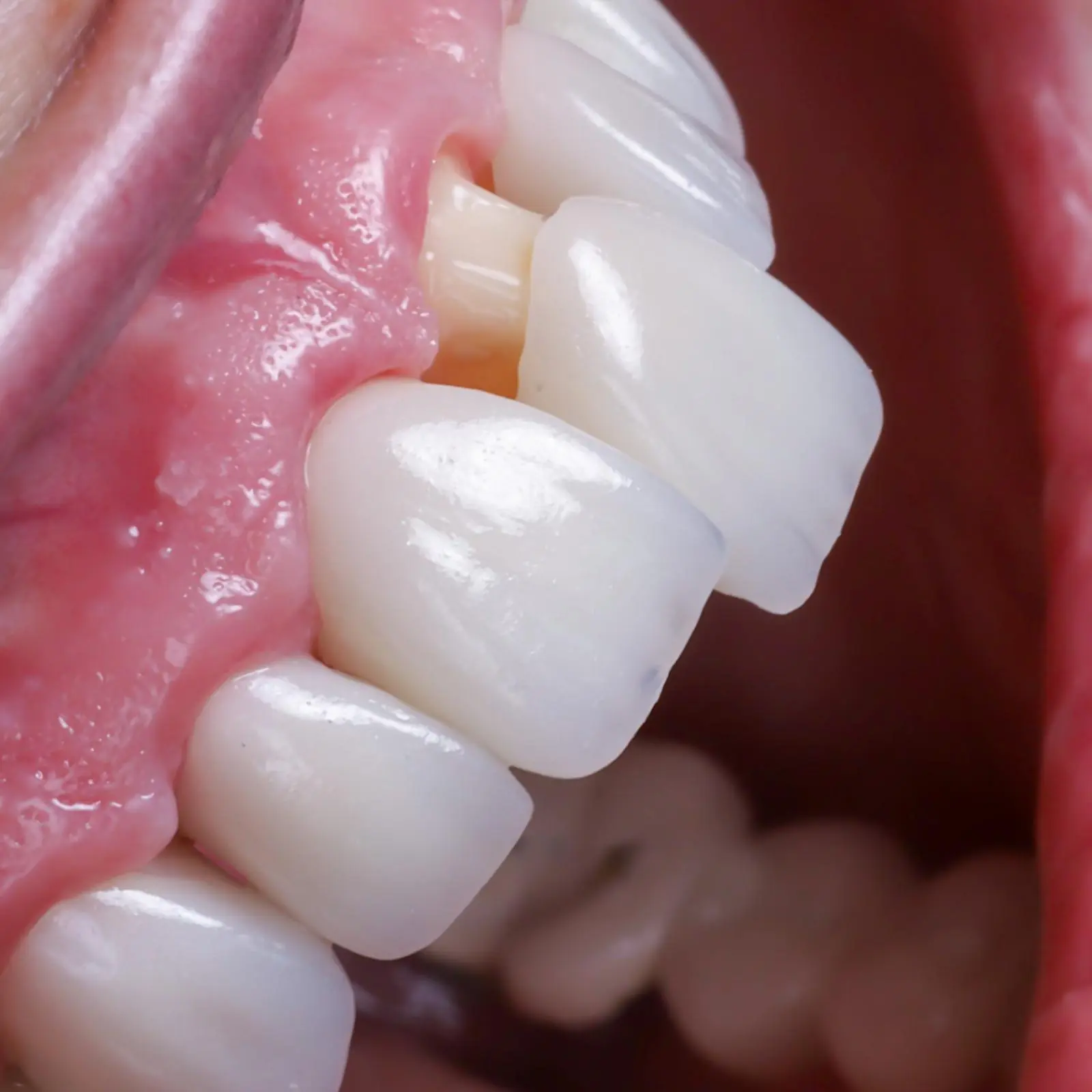 Porcelain or Zirconia Crowns & Bridges