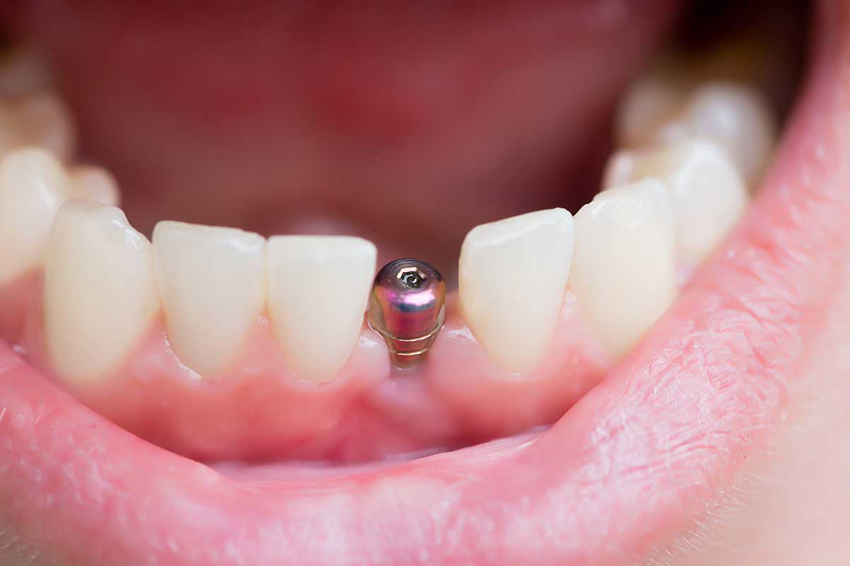 Implantes Dentales
